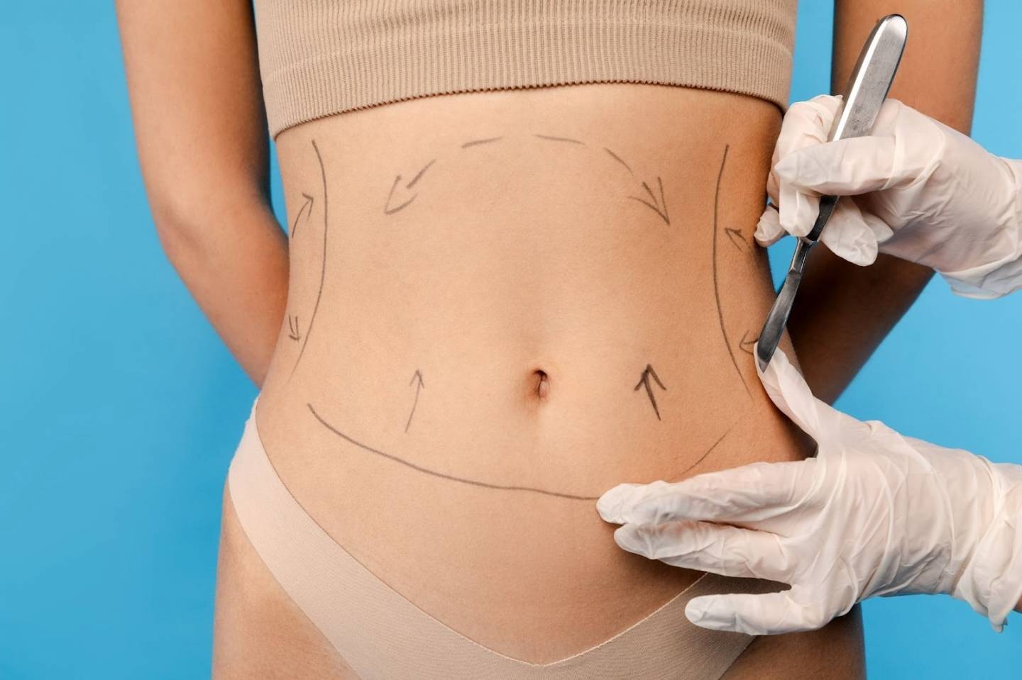 Combien coute un abdominoplastie