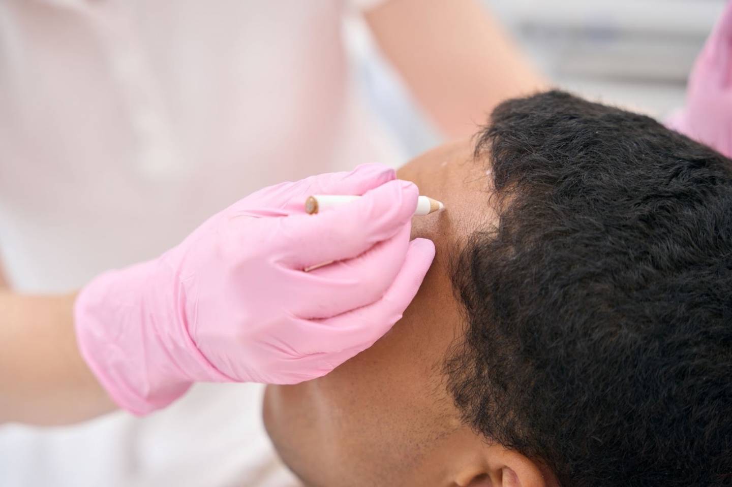 Comment fonctionne la greffe de cheveux
