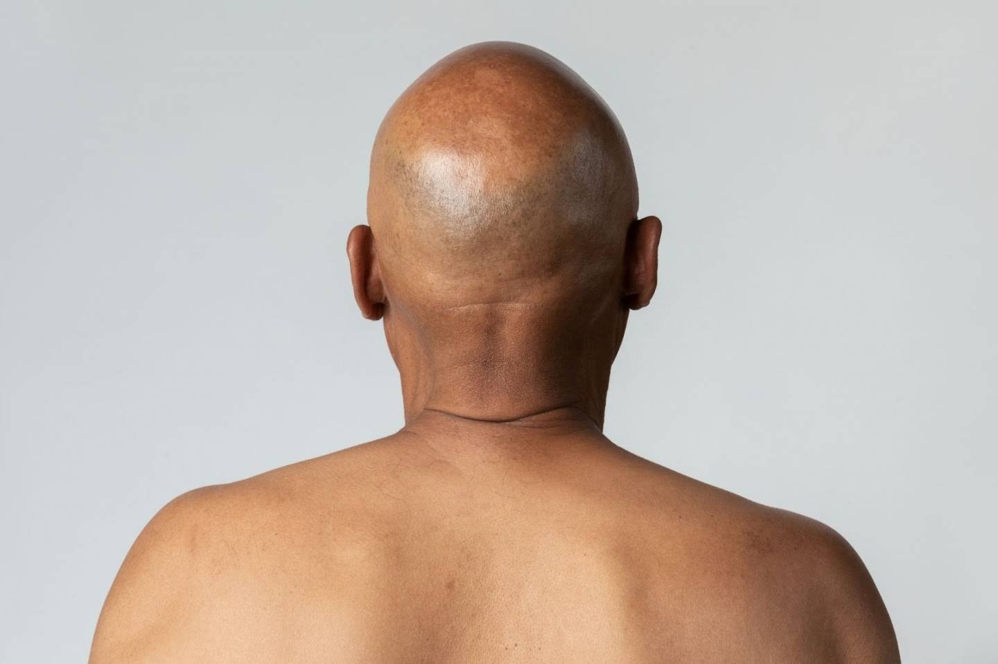 Perte de cheveux Quelles sont les causes de la calvitie