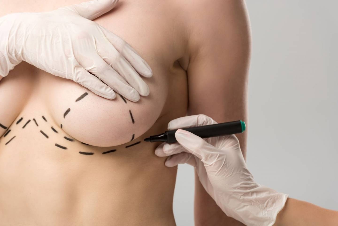 Tout ce que vous devez savoir sur les cicatrices de réduction mammaire