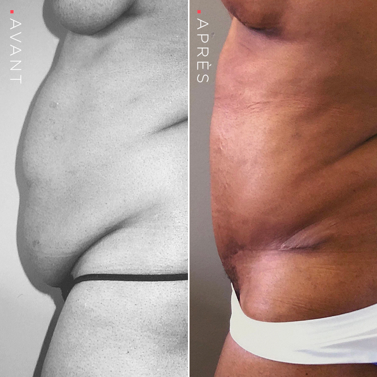 abdominoplastie-2_uid618c49140a210