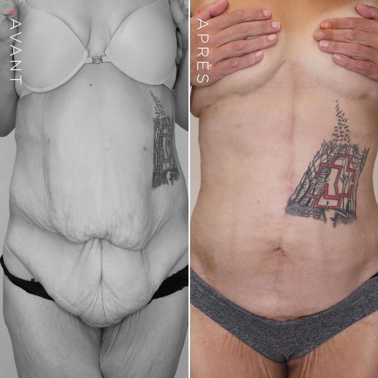 abdominoplastie-perte-de-poids_uid618bd61fe5521