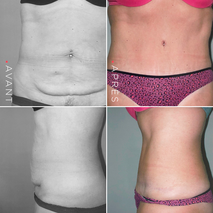 abdominoplastie_uid618c492a3ab0e