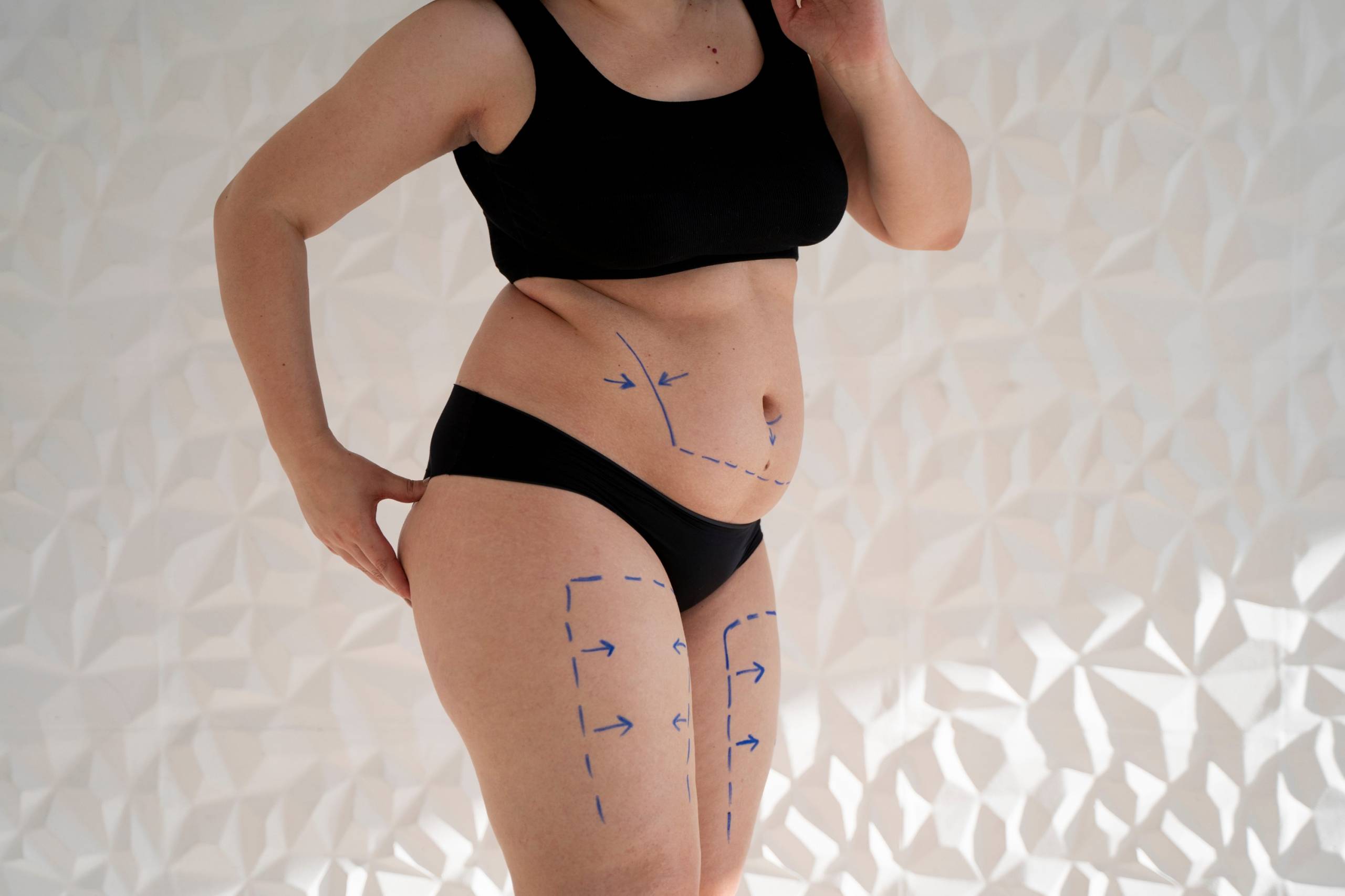 woman-s-body-with-marker-traces-side-view (1)