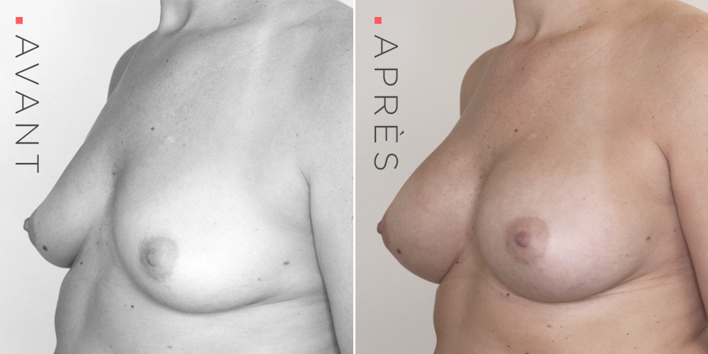augmentation-mammaire2_uid618bd5ea7ac87